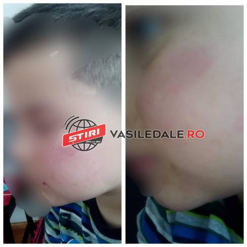 EXCLUSIV FOTO: ȘOCANT – Un băiețel de 7 ani din Repedea a fost lovit de tatăl unei colege chiar în sala de clasă în timpul orei, sub privirile îngrozite ale învățătoarei (actualizare)