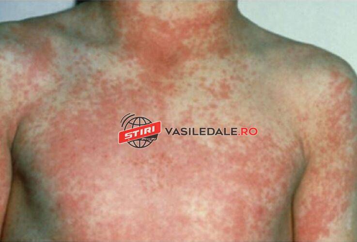 VIDEO: După valul de viroze au fost confirmate primele două cazuri de scarlatină în Baia Mare