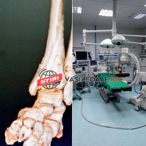 PREMIERĂ LA SPITALUL JUDEȚEAN BAIA MARE: Două tumori osoare extirpate de la ambele oase ale gambei unei fetițe de 15 ani