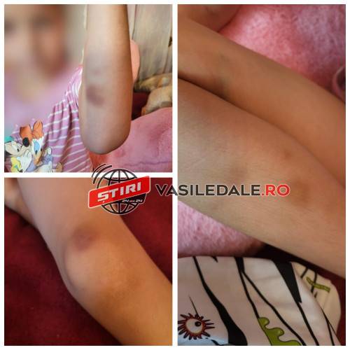 EXCLUSIV FOTO: ACUZE GRAVE – Un bărbat din Lăpuș își acuză soția că ar fi agresat-o fizic pe fiica lor de 6 anișori