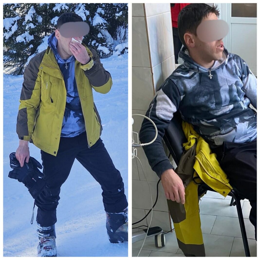 EXCLUSIV: Copil de 7 ani secerat pe pârtie de un inconștient pe pârtie olimpică de schi din Borșa. Victima internată pe neurochirurgie (foto) EXCLUSIV: Copil de 7 ani secerat pe pârtie de un inconștient pe pârtie olimpică de schi din Borșa. Victima internată pe neurochirurgie (foto)